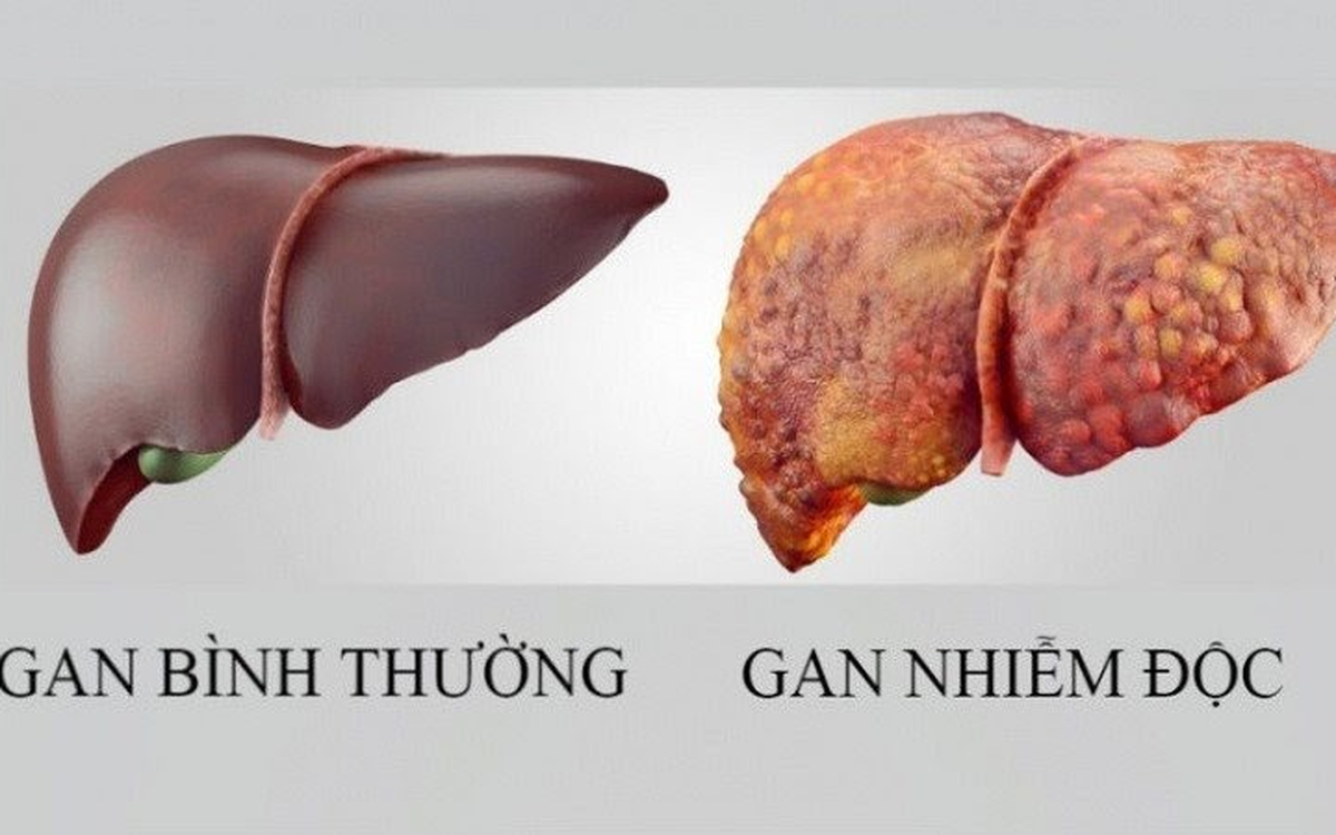 Tổng quan về giải độc gan