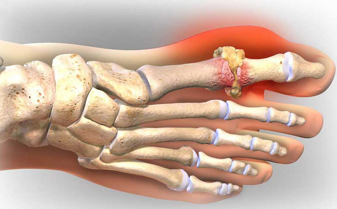 Tổng quan về bệnh gout