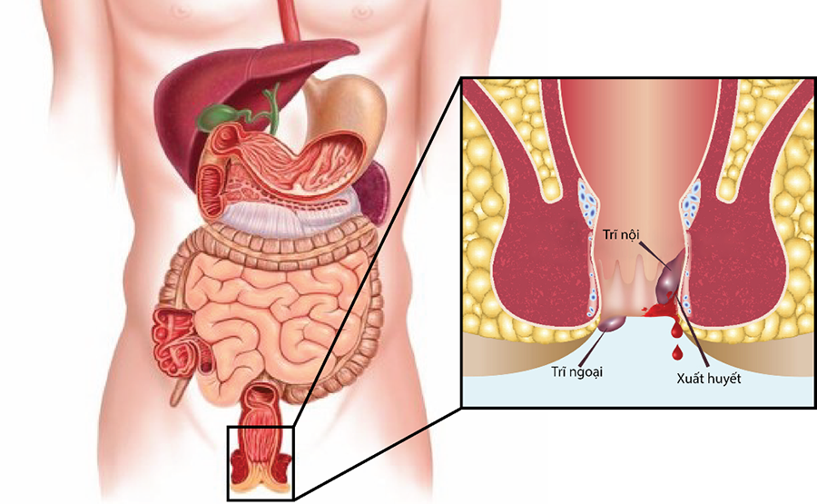 thuốc điều trị trĩ