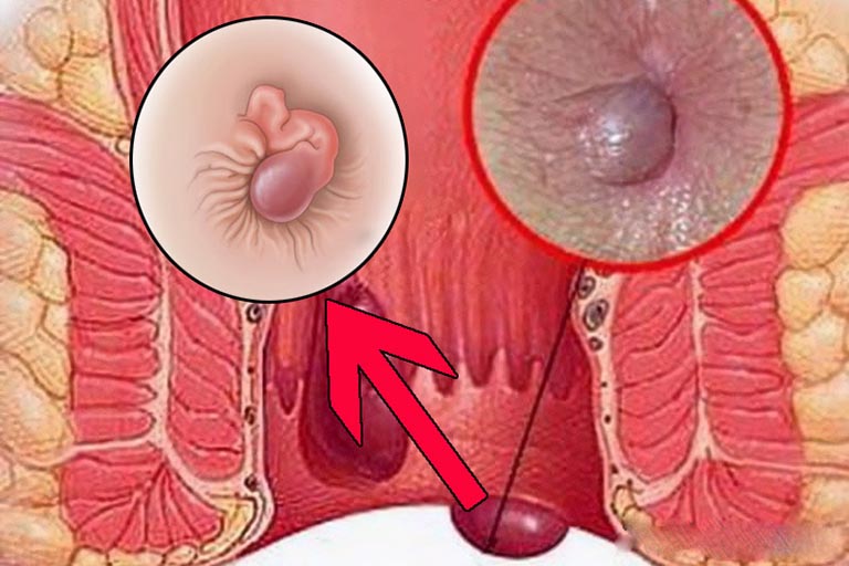 thuốc điều trị trĩ