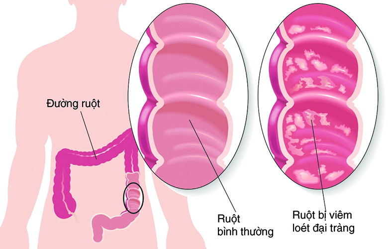 Tổng quan về bệnh viêm đại tràng