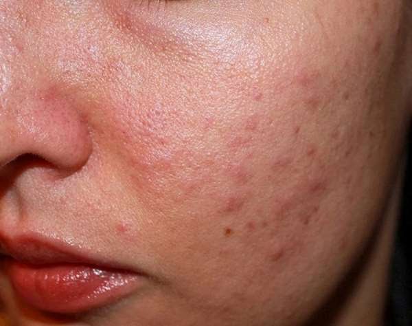 Top 10 nước tẩy trang cho da dầu lỗ chân lông to