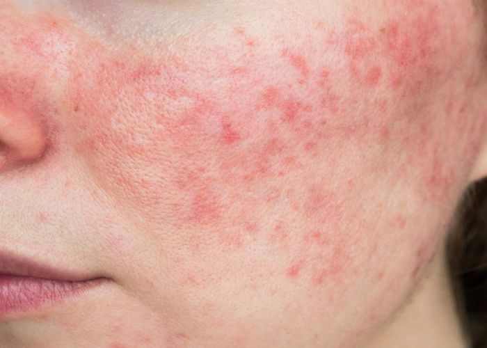 Tác hại của việc sử dụng mỹ phẩm không phù hợp với làn da