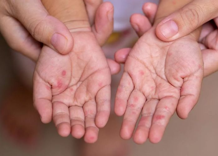 null Virus EV71 là gì ? Dấu hiệu nhận biết - biến chứng và cách phòng ngừa