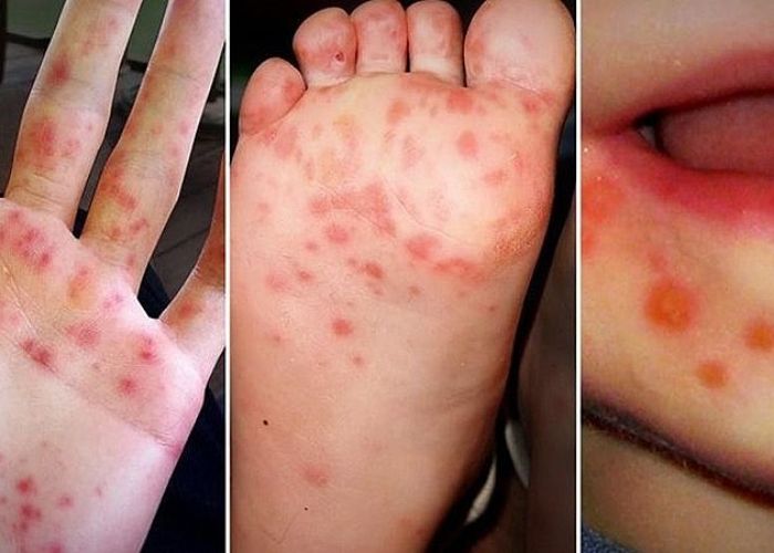 null Các dấu hiệu cảnh báo cần nhập viện ngay lập tức