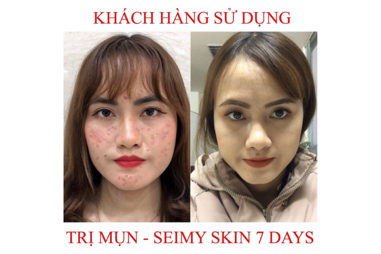 serum trị mụn Seimy có tốt không