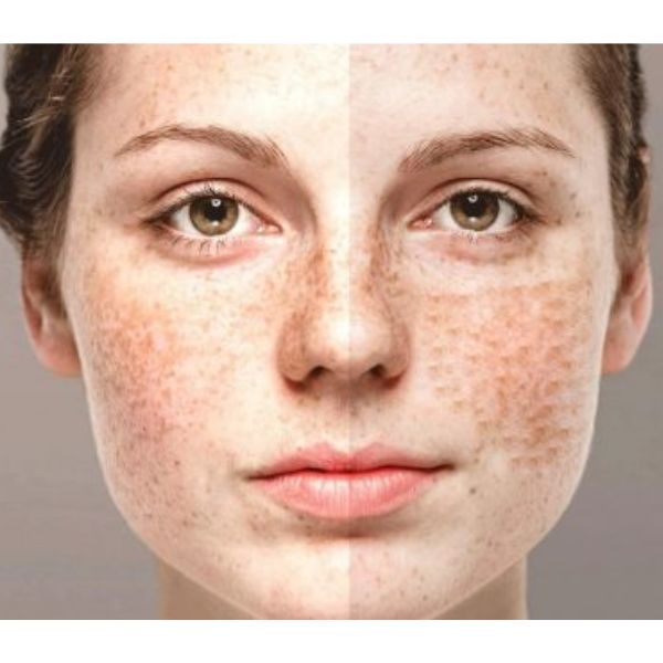 Cục quản lý Dược cảnh báo mẫu kem chuyên nám có hàm lượng thủy ngân vượt mức