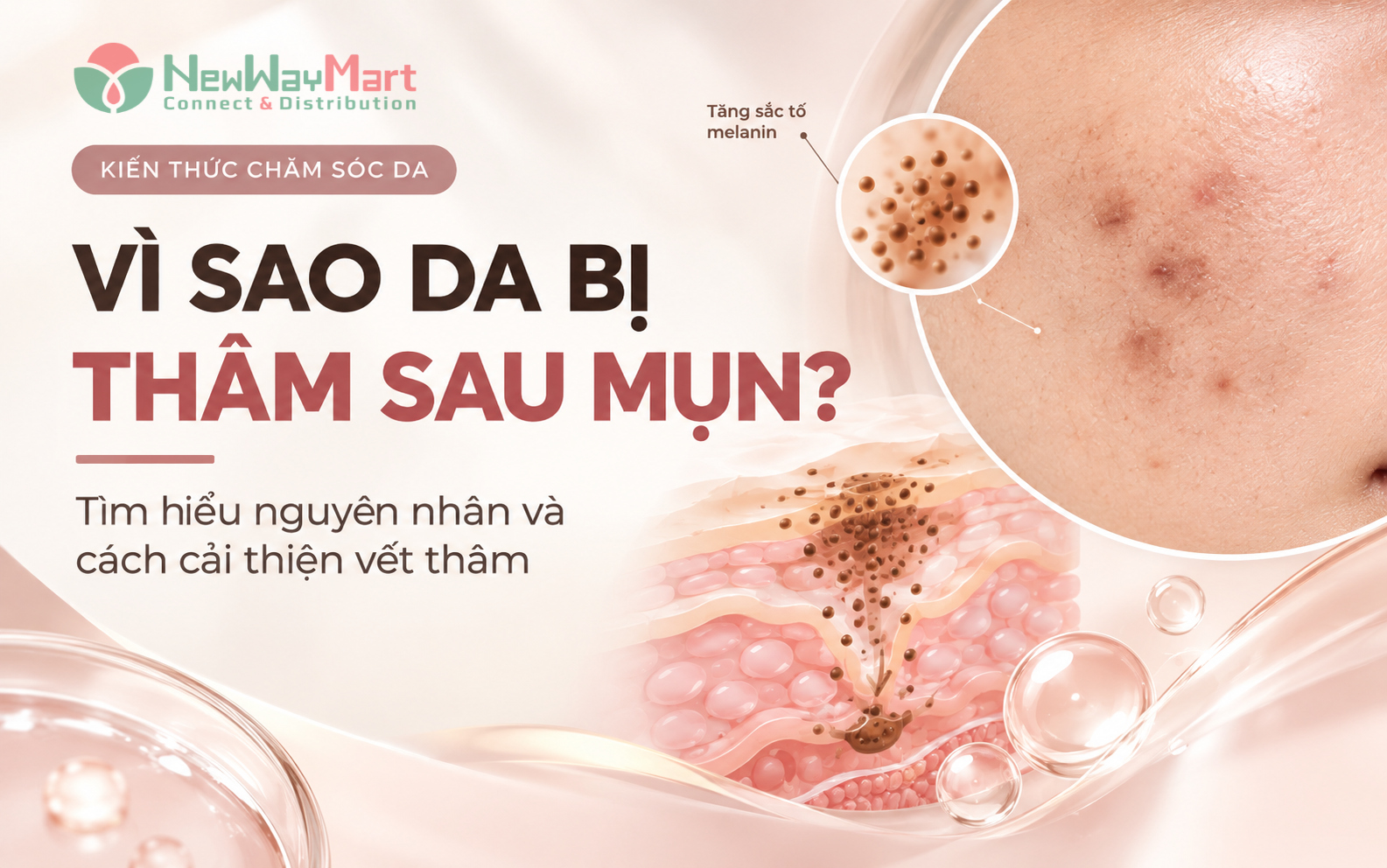 Vì sao da bị thâm sau mụn? Nguyên nhân và cách chăm sóc da sau mụn