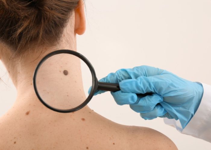 5 cách tẩy nốt ruồi tại nhà cực đơn giản hết trong 1 ngày