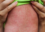 Cách phòng tránh bệnh sởi cho trẻ: Nguyên nhân, dấu hiệu và cách điều trị