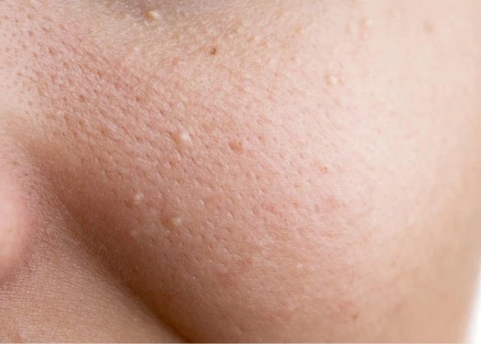 TOP 05 sản phẩm trị mụn ẩn được yêu thích nhất năm nay