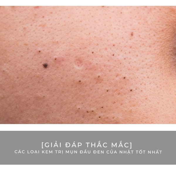 [Giải đáp thắc mắc] Các loại kem trị mụn đầu đen của Nhật tốt nhất