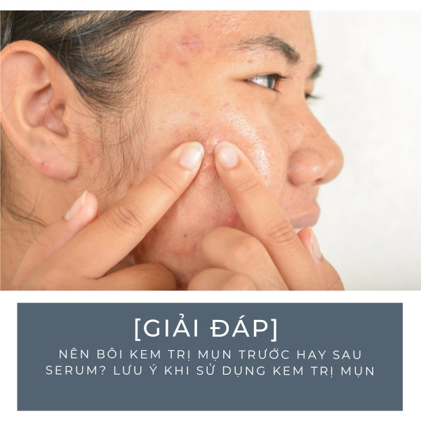 [Giải đáp] Nên bôi kem trị mụn trước hay sau serum? Lưu ý khi sử dụng kem trị mụn