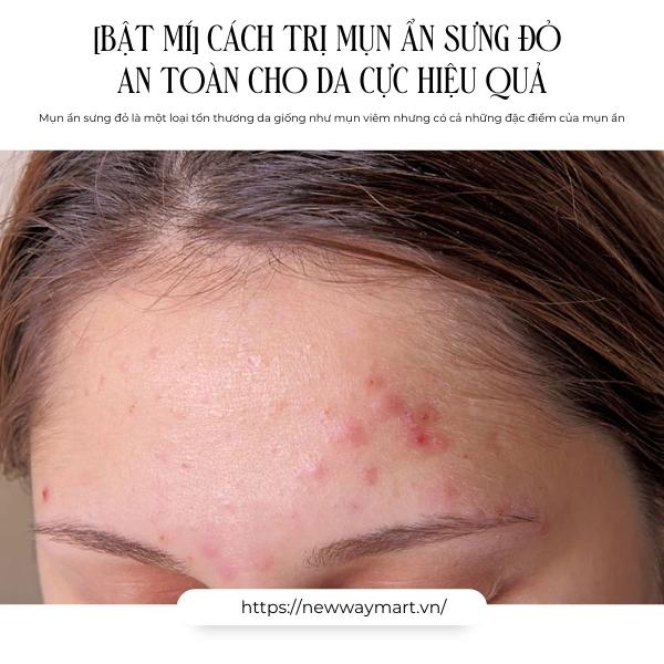 [Bật mí] Cách trị mụn ẩn sưng đỏ an toàn cho da cực hiệu quả